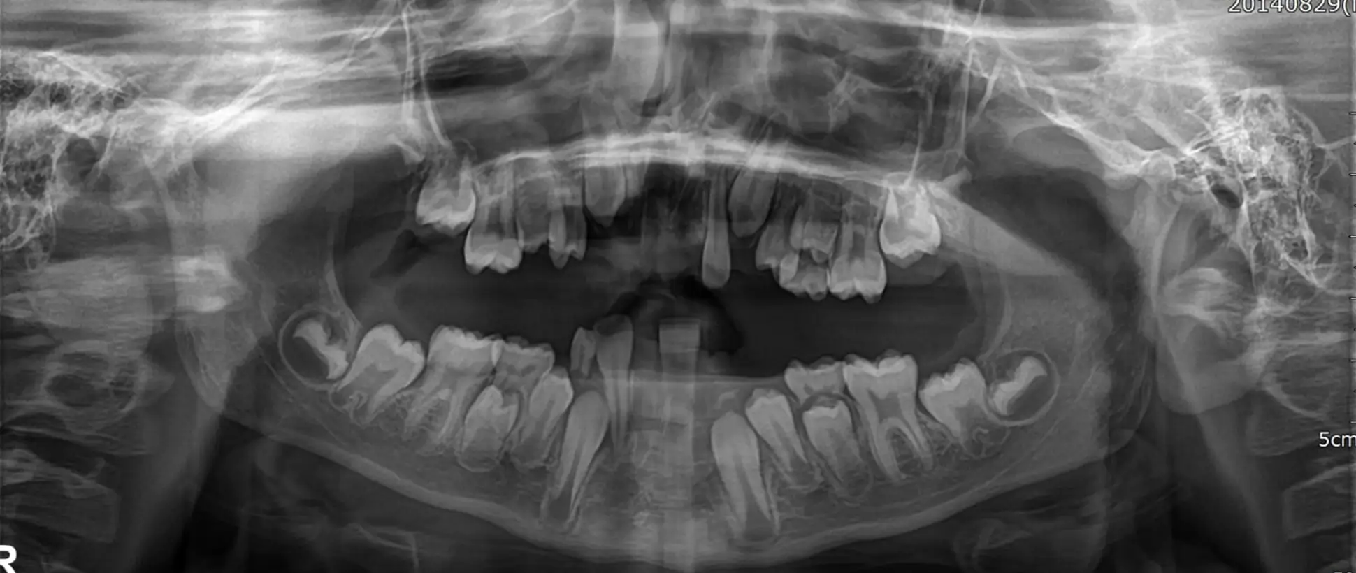 Emergency Management of Severe Dental Trauma