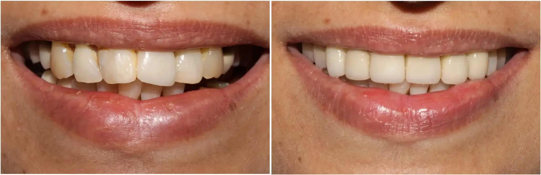 Complete Smile Makeover & Rehabilitation